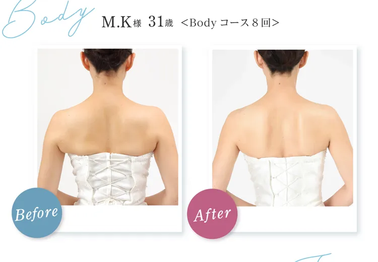 Body M.K様 31歳 Before After Body コース8回 首筋から背中がスッキリ！天使の羽根もしっかり見える状態に