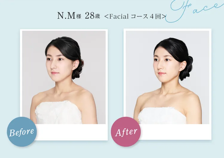 Face N.M様 28歳 Before After Facial コース4回 フェイスラインからデコルテにかけてラインがスッキリスリムに