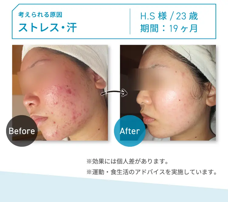 CASE05 考えられる原因：ストレス・汗 H.S様 23歳 期間：約19ヶ月 Before-After