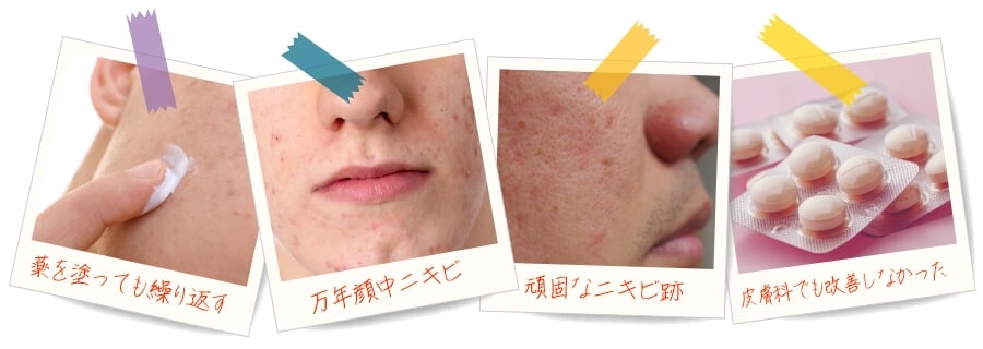 薬を塗っても繰り返す 万年顔中ニキビ 頑固なニキビ跡 皮膚科でも改善しなかった