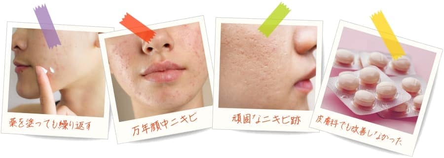 薬を塗っても繰り返す 万年顔中ニキビ 頑固なニキビ跡 皮膚科でも改善しなかった