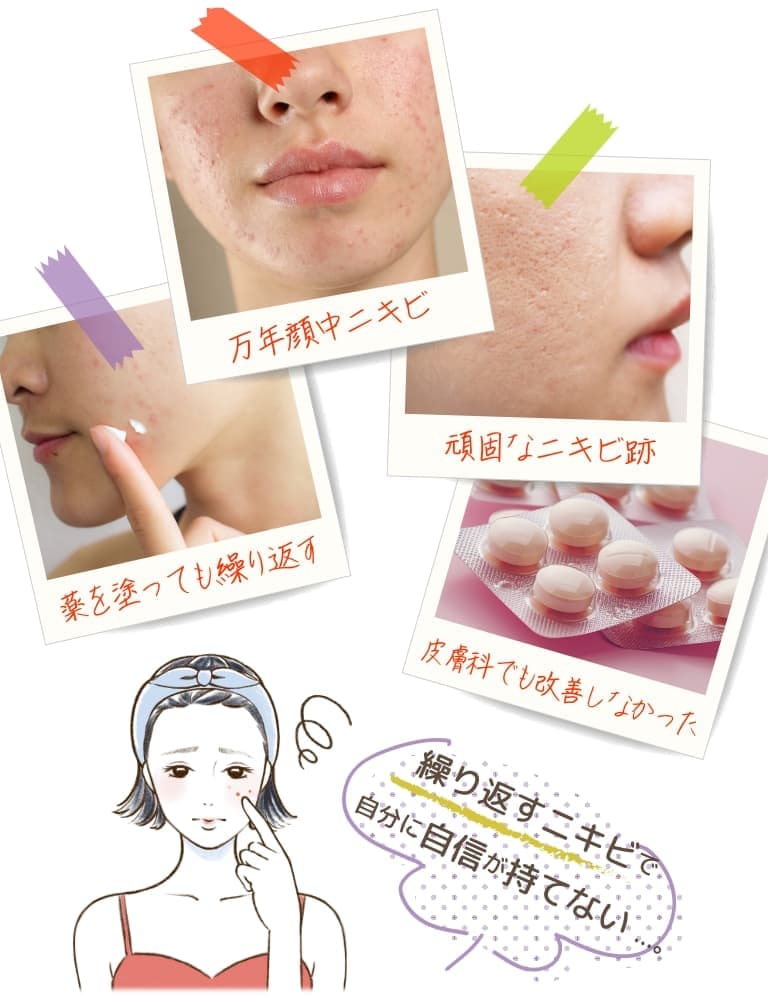 薬を塗っても繰り返す 万年顔中ニキビ 頑固なニキビ跡 皮膚科でも改善しなかった 繰り返すニキビで自分に自信が持てない…。