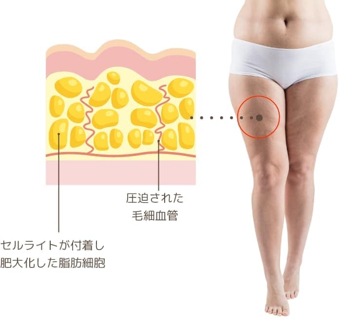 セルライトが発生した皮下組織のイメージ